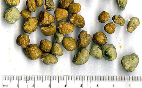 Namuong Bato sa Apdo o Gallstones — Narito ang Natural at .